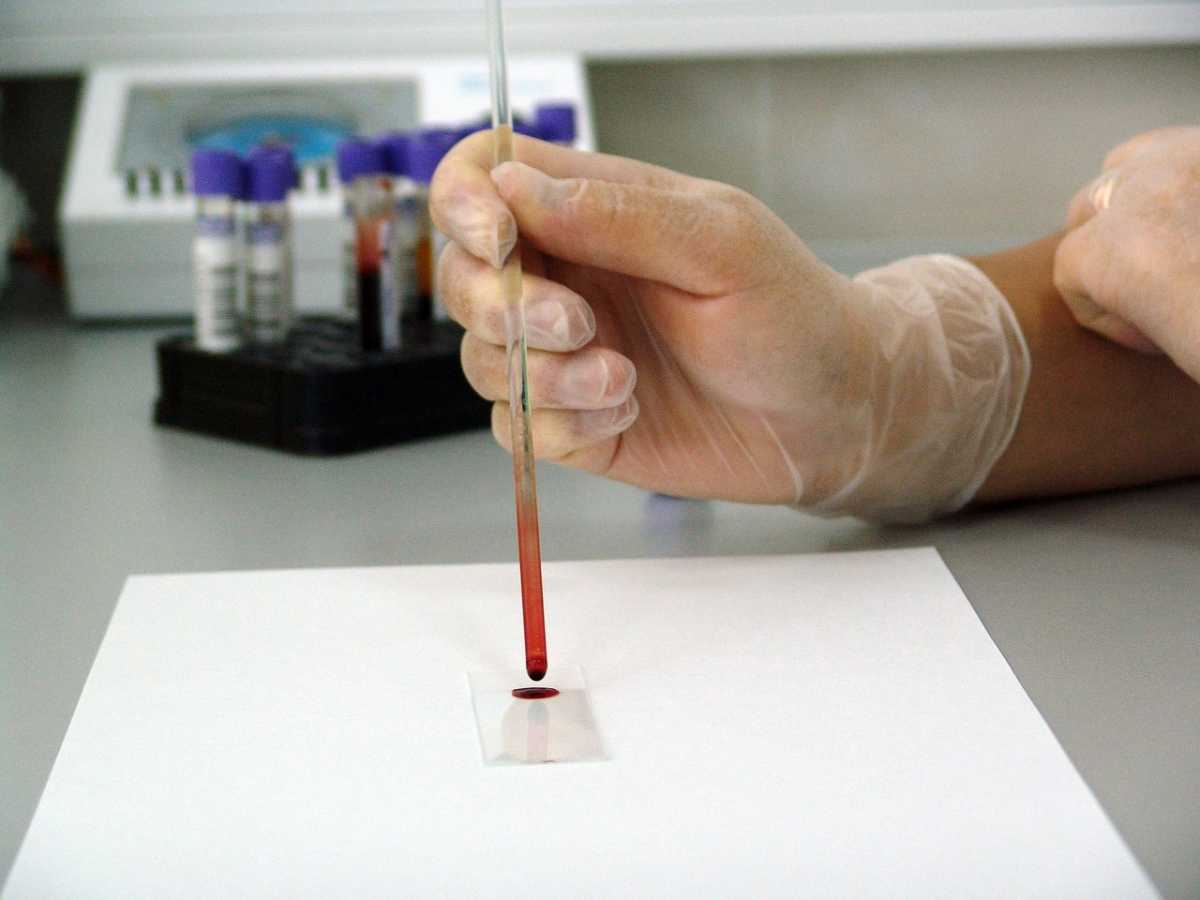 Алматы ауруханасында бірнеше науқастан АИТВ инфекциясы анықталған